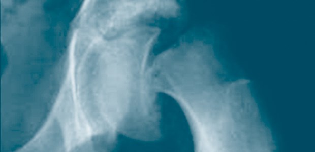 Skelett-Schäden sind programmiert Aufnahme einer akuten Epiphyseolysis capitis femoris (Hüftkopfabrutsch).