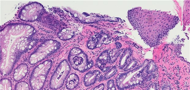 Aufnahme einer chronischen Ösophagitis bei Barrett-Ösophagus. © Ogphoto / Getty Images / iStock