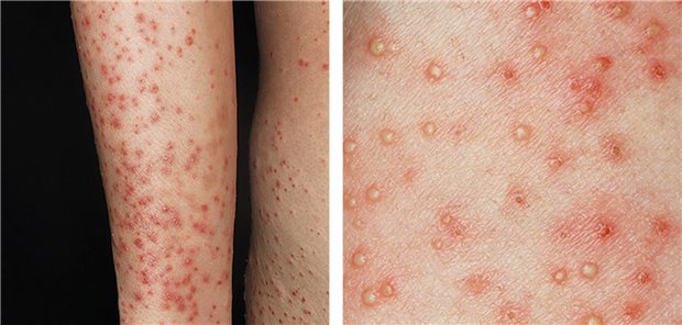 Aufnahmen des linken Armes einer 37-jährigen Schwangeren, die sich in der 30. Schwangerschaftswoche in einer Hautklinik in Tsukuba vorstellte.