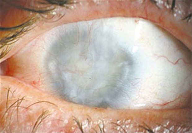Wenn Rheuma ins Auge geht Auge eines Patienten mit juveniler Arthritis und jahrelanger Uveitis. Er erblindete.