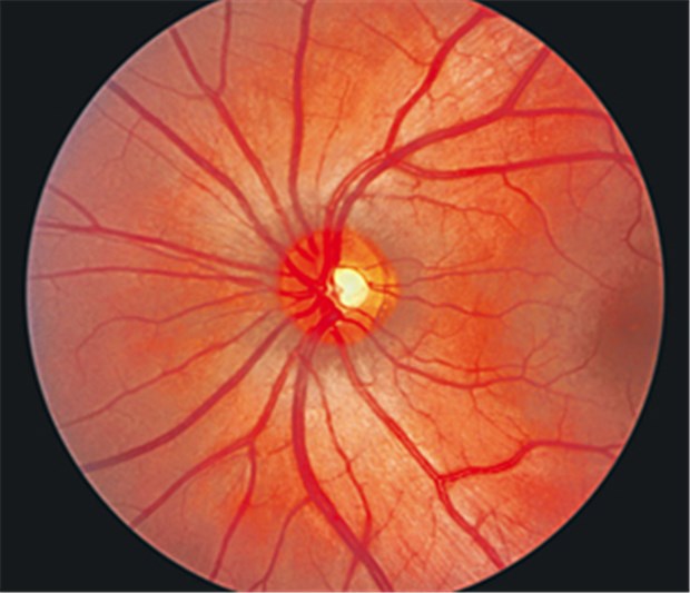 Moderne Rheuma-Mittel lindern Uveitis Augenhintergrund eines Gesunden. Bei Uveitis ist die Gewebeschicht zwischen Lederhaut und Netzhaut entzündet.