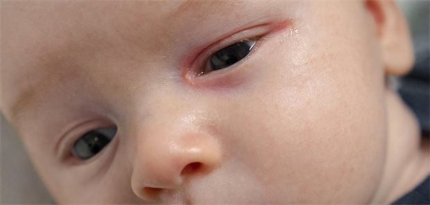 Baby mit zuviel Tränen und Schleim im Auge wegen eines verengten Tränennasengangs.