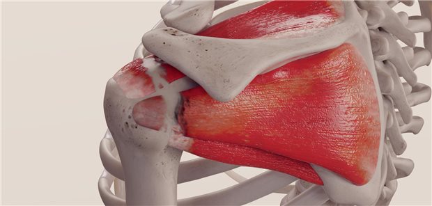 Aus Sicht des Rheumaorthopäden Dr. Martin Arbogast könne die Empfehlung ausgesprochen werden, eine klinisch symptomatische Rissbildung der Rotatorenmanschette bei Rheumapatientinnen und -patienten zu rekonstruieren.