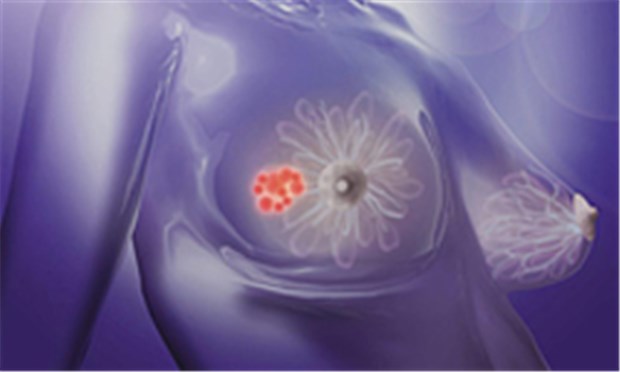 Mehr Chancen für Frauen mit BRCA-Mutation Aus groß mach klein: Mit der hohen Dosis des PARP-Hemmers verkleinerte sich der Tumor bei 41 Prozent der behandelten Frauen oder ging sogar komplett zurück.