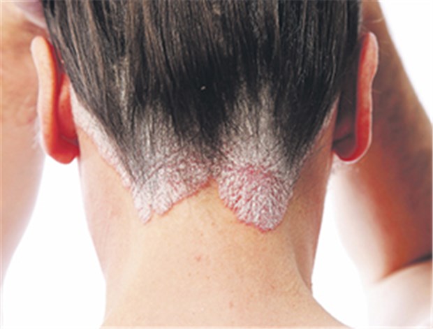 Warum Kratzen eine Psoriasis-Läsion auslöst Ausgedehnte Psoriasis am Haaransatz und auf der Kopfhaut. Bei manchen Patienten entstehen durch harmloses Kratzen neue Läsionen.