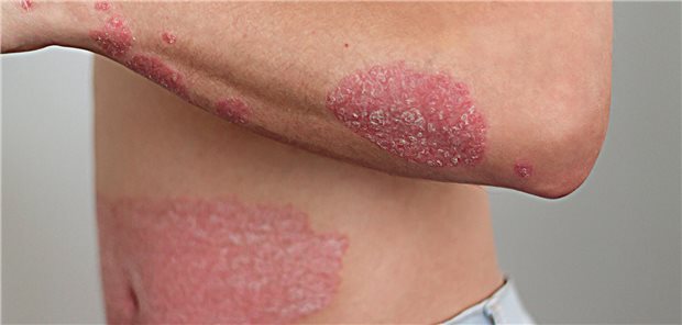 Ausgeprägte Effloreszenzen bei Psoriasis: „Multi failure“ bei Biologika hat in den letzten Jahren eher zugenommen, berichten italienische Dermatologen.
