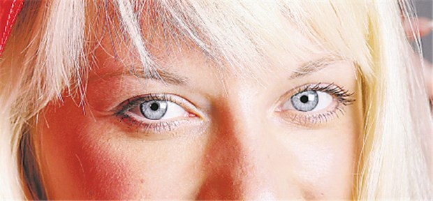 Dermalfiller beseitigen Tränenrinnen für ein Jahr Ausgeprägte Tränenrinnen können nicht-operativ durch Dermalfiller beseitigt werden.