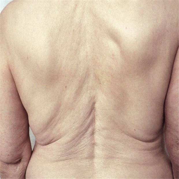 Rat zu Knochendichtemessung bei osteoporosetypischer Fraktur Ausgeprägtes Tannenbaumphänomen bei Osteoporose.