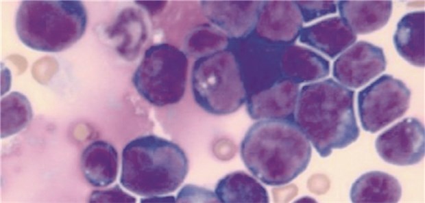 Ausstrich des Knochenmarks eines Patienten mit akuter T-Zell-Leukämie.