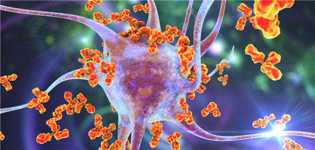 Autoantikörper, die ein Neuron attackieren: Nach einer überstandenen SARS-CoV-2-Infektion bleiben bei einem Teil der Infizierten Autoantikörper zurück.
