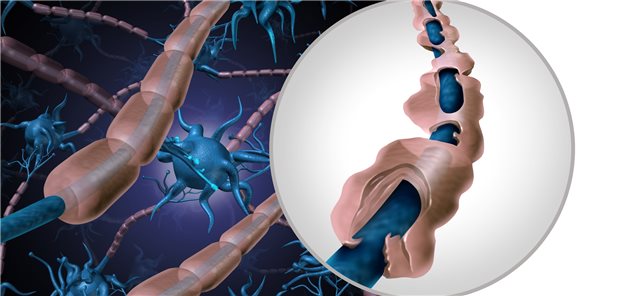 Axonaler Schaden bei Multipler Sklerose.