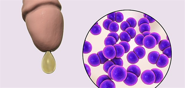 Azithromycin-Resistenzen bereiten große Sorgen, weil sie die duale Therapie bei Patienten mit Tripper – immerhin die zweithäufigste sexuell übertragene Infektion – schwächen.