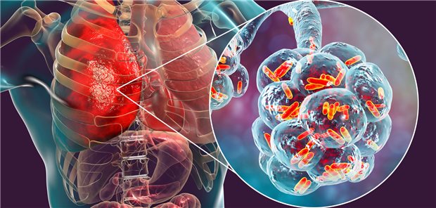 Bakterielle Pneumonie. Forschende haben jetzt getestet, was sich bei Betroffenen auf Intensiv mit Hydrocortison-Infusionen erreichen lässt.
