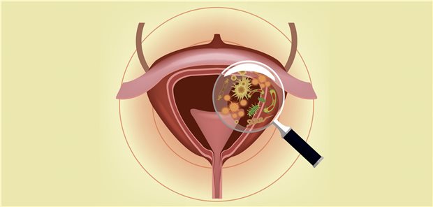Bakterien in der Blase und im Urin: Wann muss gehandelt werden, wann ist ein Antibiotikum indiziert?