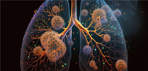 Bakterienbefall der Lunge: Forschende haben die Verbindungen zwischen einzelnen Bakterienspezies in der Lunge und Markern im Wirtsgenom untersucht, um Gene zu identifizieren, die die Lungenbakterien beeinflussen und möglicherweise eine Rolle bei der Krankheitsanfälligkeit spielen.