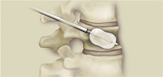 Ballonkyphoplastie: Der frakturierte Wirbelkörper wird mit einem Ballon geweitet und im Anschluss durch Einbringen von Zement stabilisiert. Eine frühe Behandlung nach der Fraktur führt offenbar zu besseren röntgenologischen Ergebnissen.