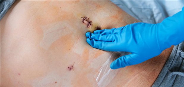 Bancke Laverde und Kollegen resümieren, dass nach einer Appendektomie wegen komplizierter Appendizitis eine kurzzeitige Antibiotikagabe zu bevorzugen sei, nicht zuletzt aus Kostengründen. 