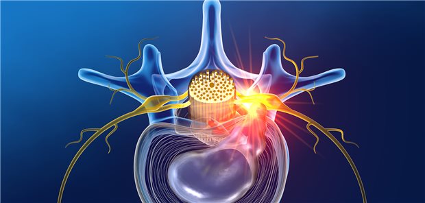 Bandscheibenvorfall: der Druck auf die Nervenwurzel ruft neuropathische, radikuläre Schmerzen hervor.