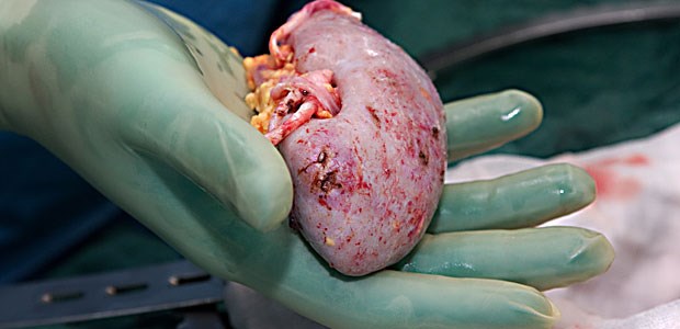 Patient: Es fehlen Organspender Banges Warten auf eine neue Niere: Alltag für rund 8000 Patienten in Deutschland.