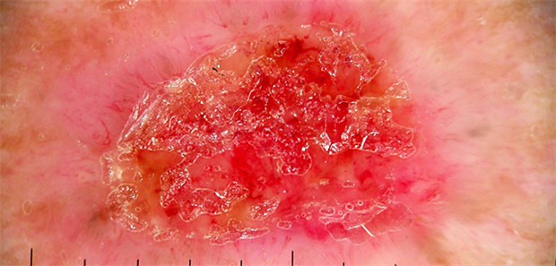 Basaliom: Bevorzugte Lokalisationen sind der Sonne ausgesetzteGesichtsregionen.