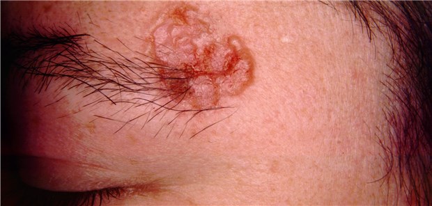 Basalzellkarzinom: Auch bei metastasiertem Karzinom erzielen Hedgehog-Inhibitoren Anprechraten von bis zu 30 Prozent.