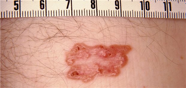 Basalzellkarzinom: Mit Hilfe der 3-D-Histologie lassen sich Auswüchse von Tumoren an den Exzisionsrändern erkennen.