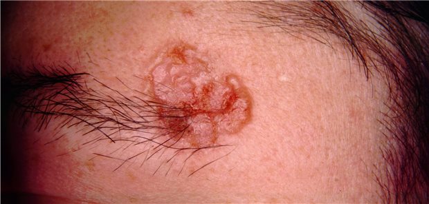 Basalzellkarzinom an der Schläfe. Wichtig ist nicht nur die Exzision, sondern auch die ästhetisch adäquate Rekonstruktion.