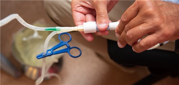 Bauchfelldialyse – beliebt bei Patienten mit Nierenversagen. Der Genotyp hat einen Einfluss auf den Erfolg. 