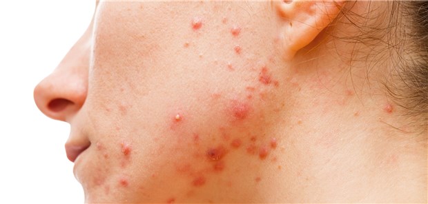 Befund bei Akne: Unter der antibiotischen Therapie nahm unter anderem die Keimzahl von Lactobacillus ab. Lactobacillus-Spezies sollen vor Akne schützen.