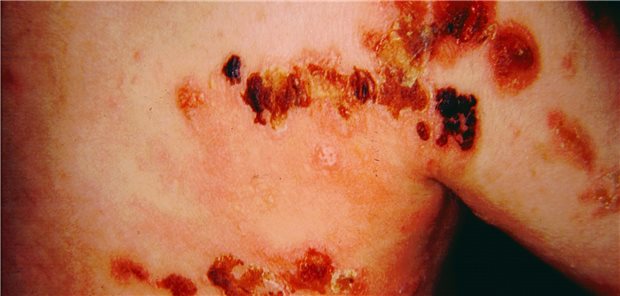 Befund bei Epidermolysis bullosa hereditaria am Rumpf eines sechs Monate alten Säuglings.