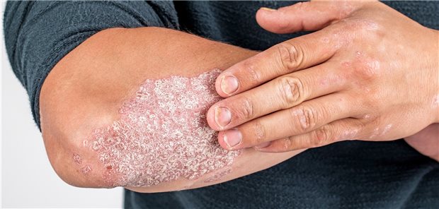 Befund bei Psoriasis. Gerade bei Hautkrankheiten macht es Sinn, gezielt danach zu fragen, wie sehr Betroffene darunter leiden – und gegebenenfalls gegenzusteuern.
