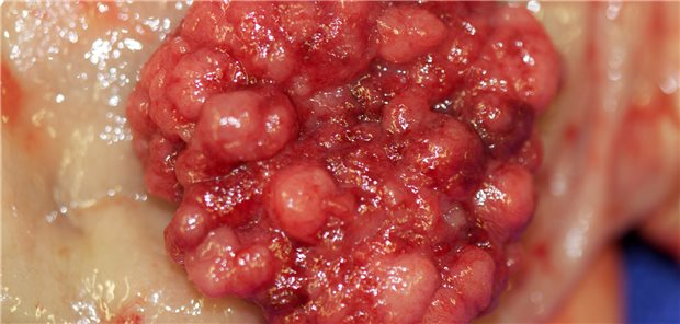 Befund bei Rektumkarzinom.