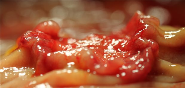 Befund bei Rektumkarzinom.