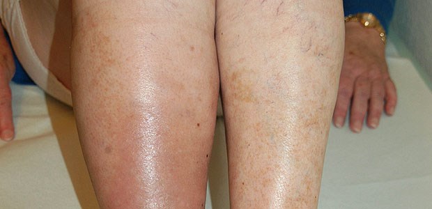 Rheuma-Kranke besonders gefährdet Befund bei idiopathischer Beinvenenthrombose.