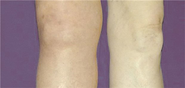 Wie lang antikoagulieren bei TVT? Befund bei venöser Thrombose im rechten Bein; das Bein ist deutlich geschwollen und verfärbt.
