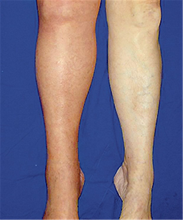 So lange sollte die Thromboseprophylaxe dauern Befund bei venöser Thrombose im rechten Bein; das Bein ist deutlichgeschwollen und verfärbt.