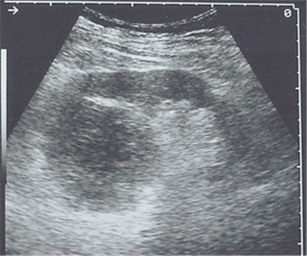 1996: Der Fortschritt in der Medizintechnik Befund im Schneegestöber: Ultraschall-Aufnahme bei einem Patienten mit einem metastasierten Nierenzellkarzinom.