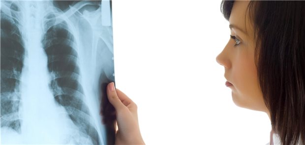 Begutachtung eines Röntgen-Thorax: COVID-19 lässt sich bei unauffälligen Bildern nicht sicher ausschließen.