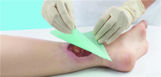 Behandlung einer chronischen Wunde durch eine Pflegekraft. Ein aktueller Gesetzentwurf aus dem Gesundheitsministerium soll Pflegekräften je nach Ausbildung mehr Kompetenzen einräumen.