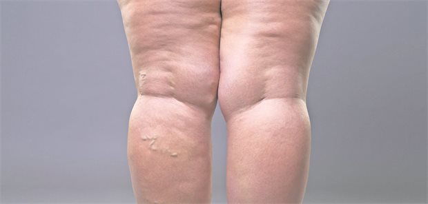 Beine einer Frau von dorsal mit Lipödem