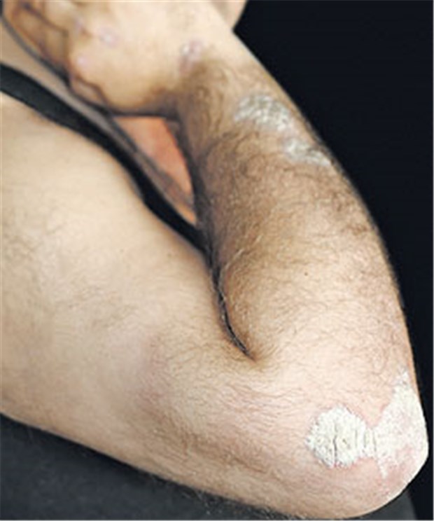 Bei 70 Prozent der Patienten mit Psoriasis-Arthritis geht die Hauterkrankung der Gelenkerkrankung voraus.