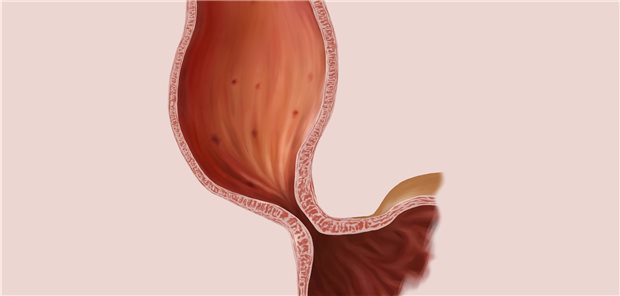 Bei Achalasie öffnet der untere Ösophagussphinkter nicht richtig.