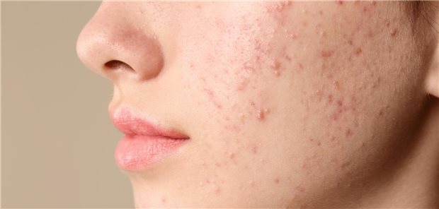 Bei Akne ist Isotretinoin ein probates Mittel.