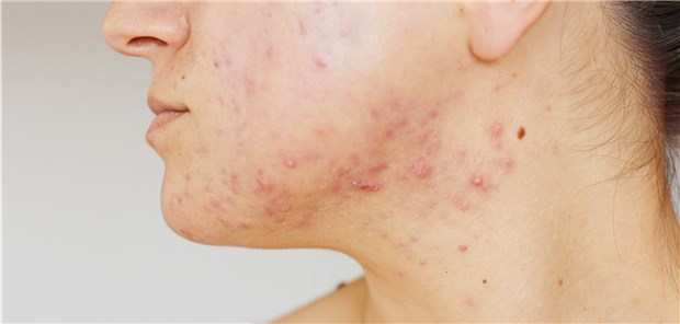 Bei Akne leidet oft auch die Psyche: Viele der Betroffenen fühlen sich in ihrem sozialen Leben und im Berufsleben eingeschränkt. 