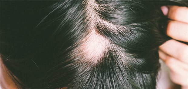 Bei Alopecia areata, hier noch in einem leichten Fall, führen die verfügbaren Therapieoptionen oft zu Nebenwirkungen und Rezidiven.