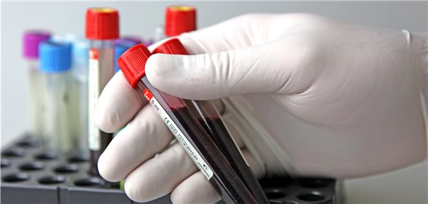 Bei Anämiesymptomen nur das Blut untersuchen? Ursachen von Symptomen wie Fatigue und Dyspnoe können mehr als die Anämie sein.