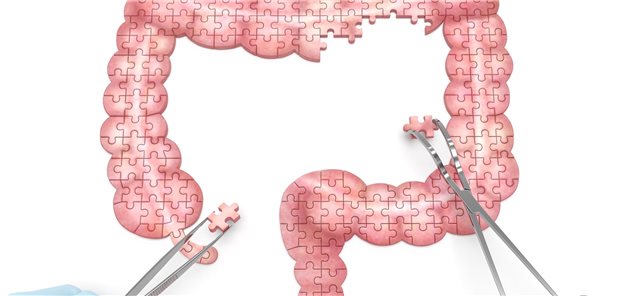 Bei Divertikulitis elektiv operieren? Patienten mit Immunsuppression profitieren offenbar.