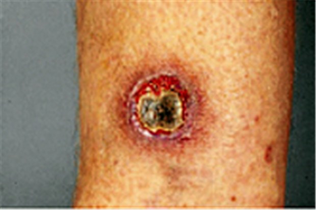 Die Haut - ein Spiegel internistischer Erkrankungen Bei Erkrankungen des Magen-Darm-Trakts treten oft Hautsymptome auf. Bei entzündlichen Darmerkrankungen häufig zu finden: Pyoderma gangraenosum.