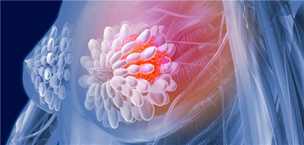 Bei Frauen, die im Kindesalter an Krebs erkrankt waren, ist das Risiko, an Brustkrebs zu erkranken, über die Jahre leicht gesunken. Das hängt wohl vor allem mit dem zurückhaltenderen Einsatz von Bestrahlungen der Brust zusammen.
