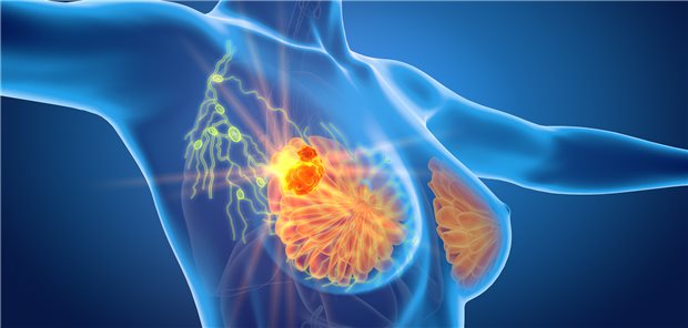 Mammakarzinom sowie Lymphknoten bei der 3D-Darstellung einer Frau.